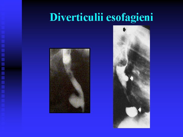 Diverticulii esofagieni Diverticulii esofagieni