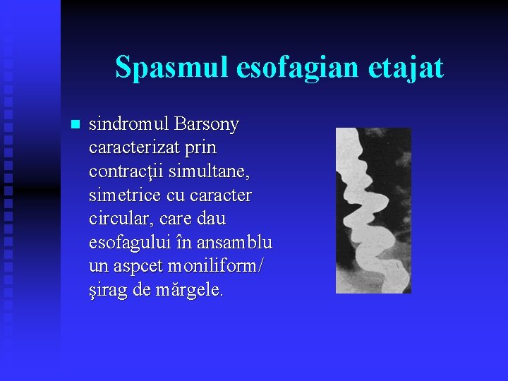 Spasmul esofagian etajat n sindromul Barsony caracterizat prin contracţii simultane, simetrice cu caracter circular, Spasmul esofagian etajat n sindromul Barsony caracterizat prin contracţii simultane, simetrice cu caracter circular,
