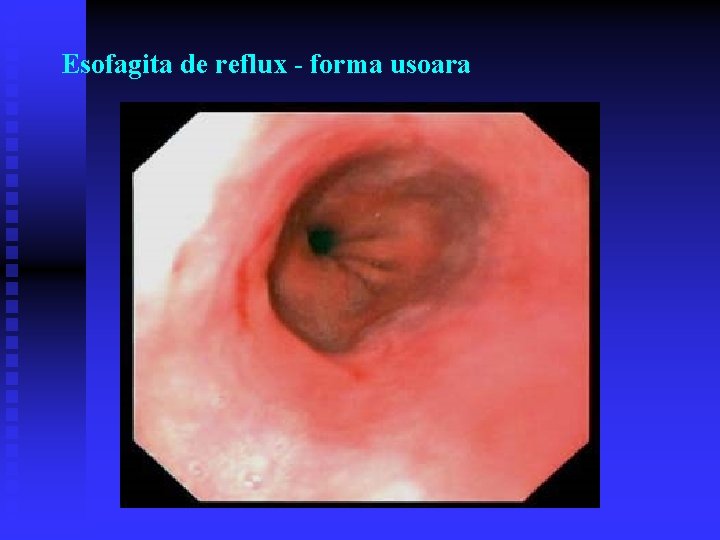 Esofagita de reflux - forma usoara Esofagita de reflux - forma usoara