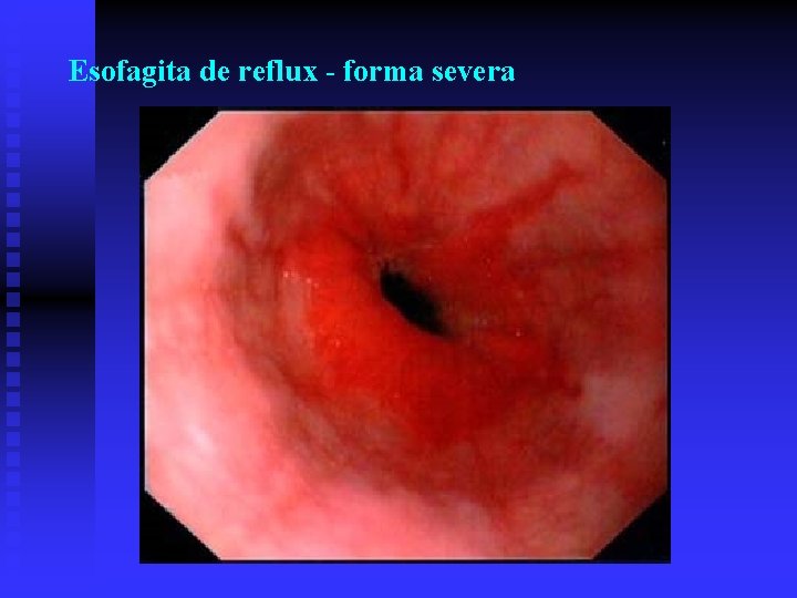 Esofagita de reflux - forma severa Esofagita de reflux - forma severa