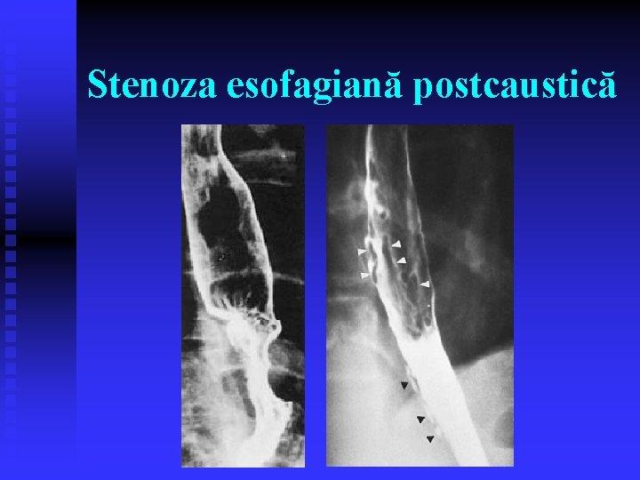 Stenoza esofagiană postcaustică Stenoza esofagiană postcaustică