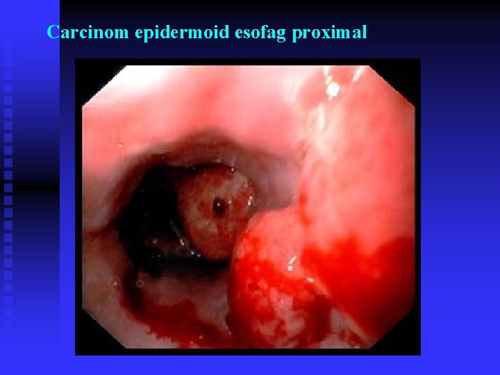 Carcinom epidermoid esofag proximal Carcinom epidermoid esofag proximal
