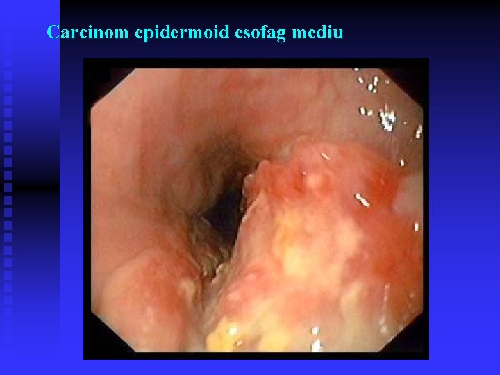 Carcinom epidermoid esofag mediu Carcinom epidermoid esofag mediu