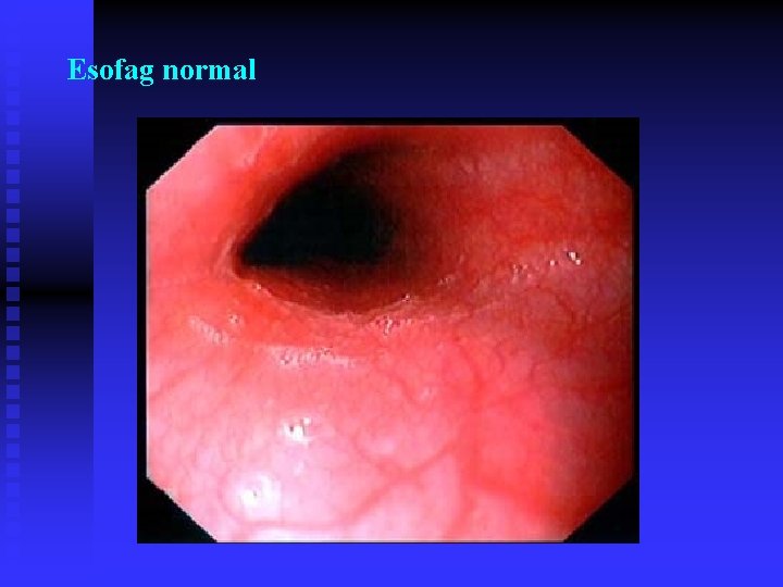 Esofag normal Esofag normal