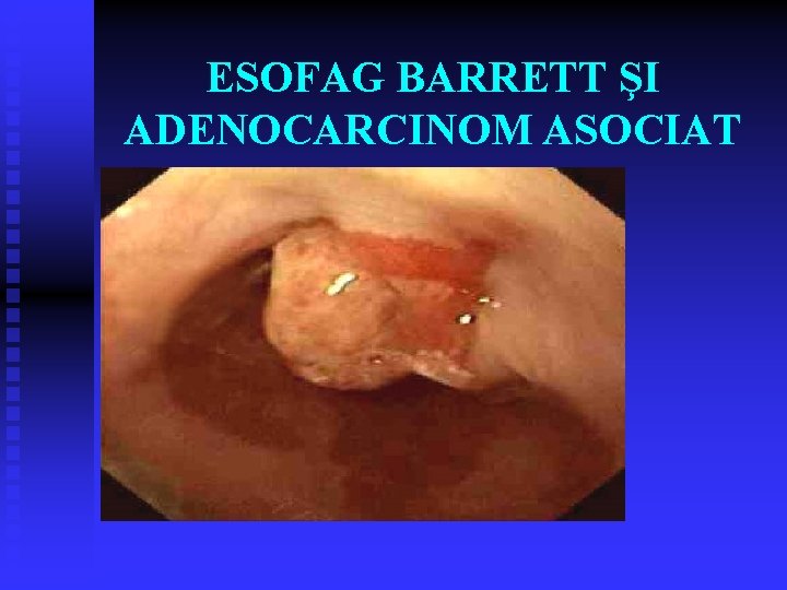 ESOFAG BARRETT ŞI ADENOCARCINOM ASOCIAT ESOFAG BARRETT ŞI ADENOCARCINOM ASOCIAT