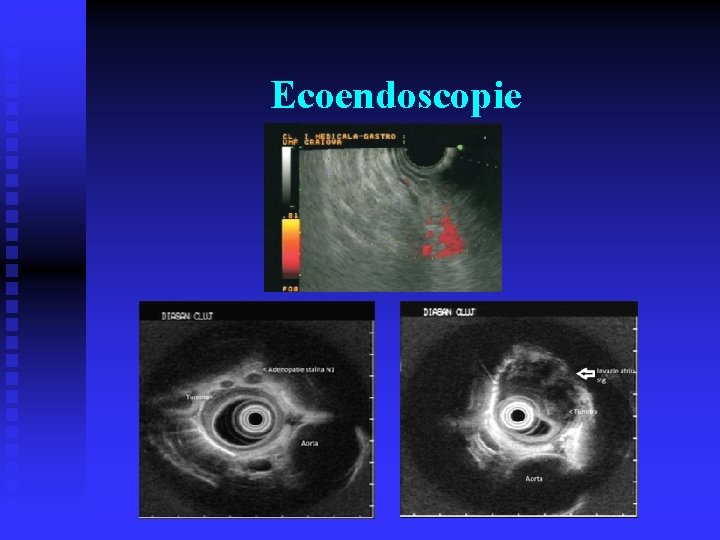Ecoendoscopie Ecoendoscopie