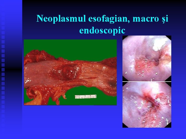 Neoplasmul esofagian, macro şi endoscopic Neoplasmul esofagian, macro şi endoscopic