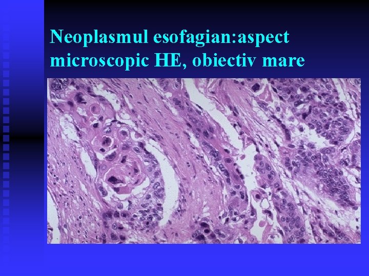 Neoplasmul esofagian: aspect microscopic HE, obiectiv mare Neoplasmul esofagian: aspect microscopic HE, obiectiv mare