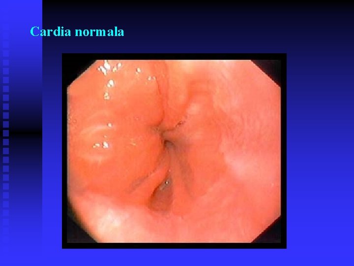 Cardia normala Cardia normala