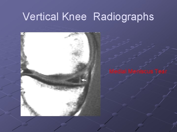 Vertical Knee Radiographs Medial Meniscus Tear 