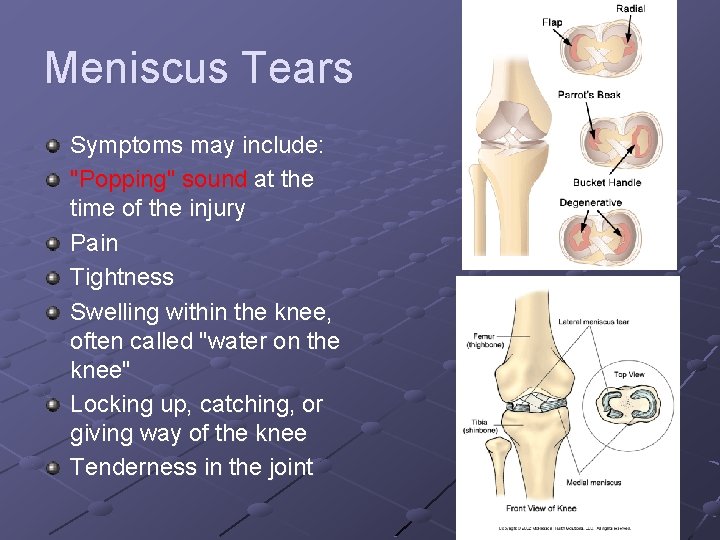 Meniscus Tears Symptoms may include: "Popping" sound at the time of the injury Pain