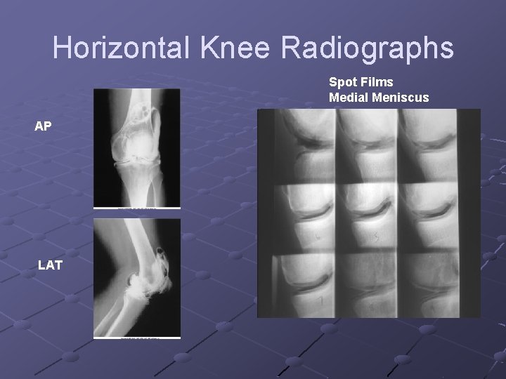 Horizontal Knee Radiographs Spot Films Medial Meniscus AP LAT 