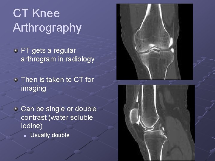 CT Knee Arthrography PT gets a regular arthrogram in radiology Then is taken to