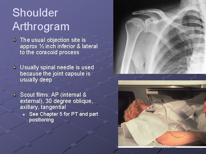 Shoulder Arthrogram The usual objection site is approx ½ inch inferior & lateral to
