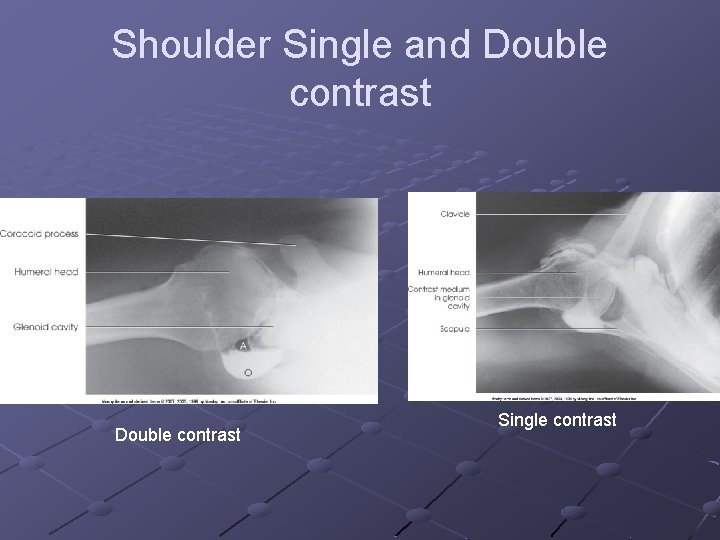Shoulder Single and Double contrast Single contrast 