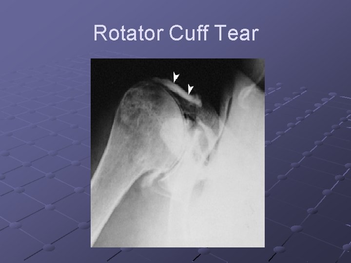Rotator Cuff Tear 