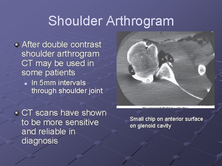 Shoulder Arthrogram After double contrast shoulder arthrogram CT may be used in some patients