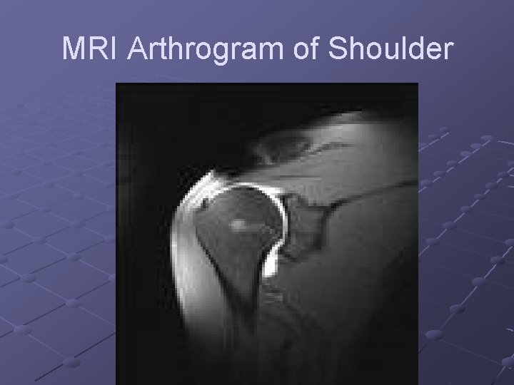 MRI Arthrogram of Shoulder 