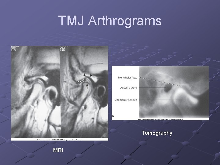 TMJ Arthrograms Tomography MRI 