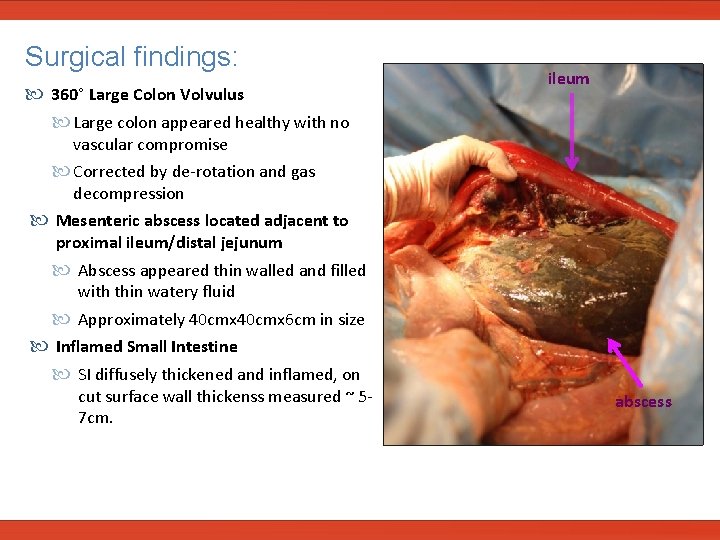  Surgical findings: 360° Large Colon Volvulus Large colon appeared healthy with no ileum