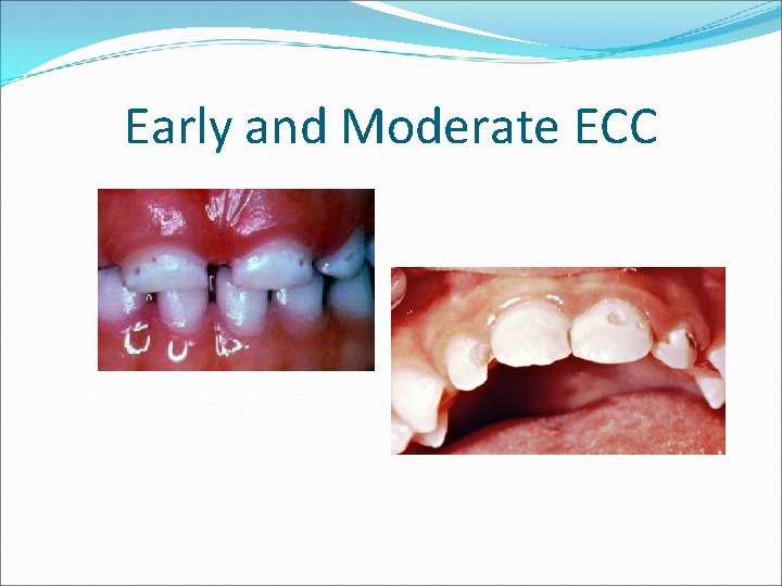 Early and Moderate ECC 
