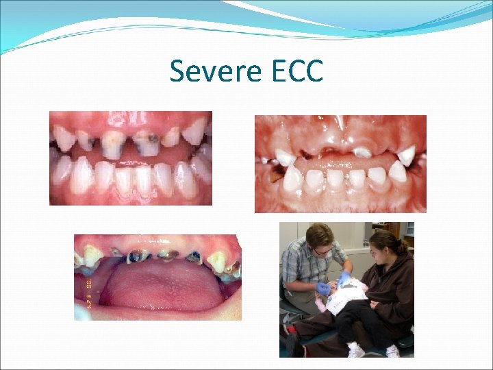 Severe ECC 
