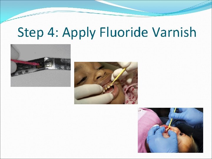 Step 4: Apply Fluoride Varnish 