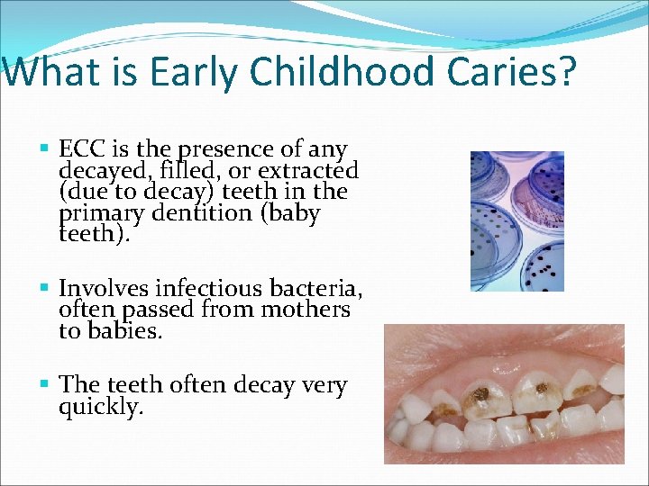 What is Early Childhood Caries? § ECC is the presence of any decayed, filled,