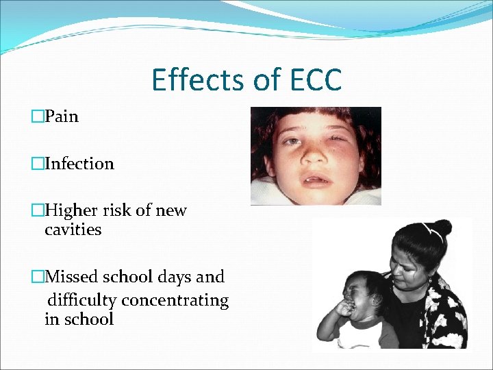 Effects of ECC �Pain �Infection �Higher risk of new cavities �Missed school days and