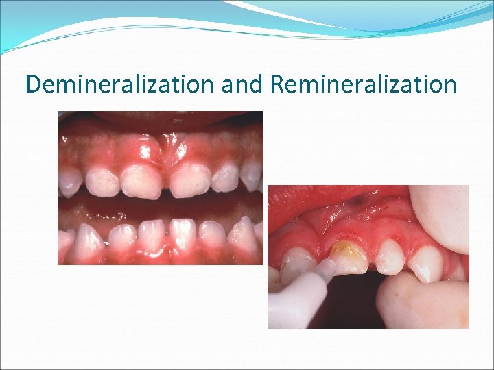 Demineralization and Remineralization 