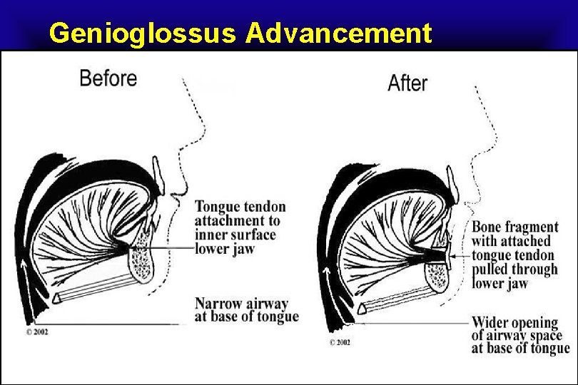 Genioglossus Advancement 