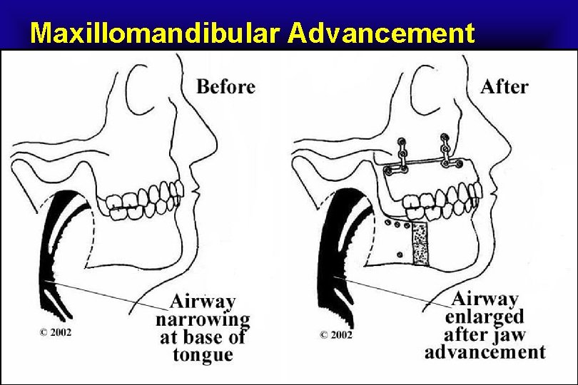 Maxillomandibular Advancement 
