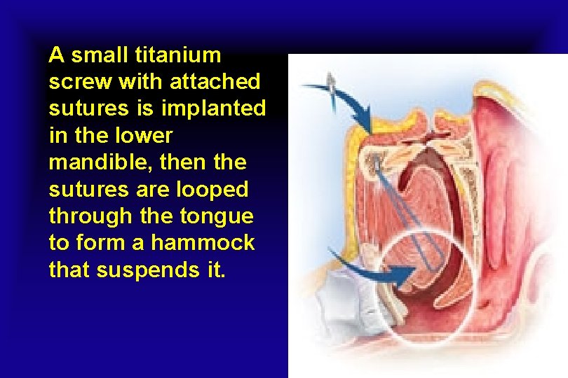 A small titanium screw with attached sutures is implanted in the lower mandible, then