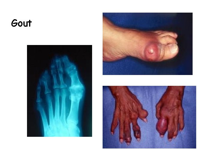 Gout 