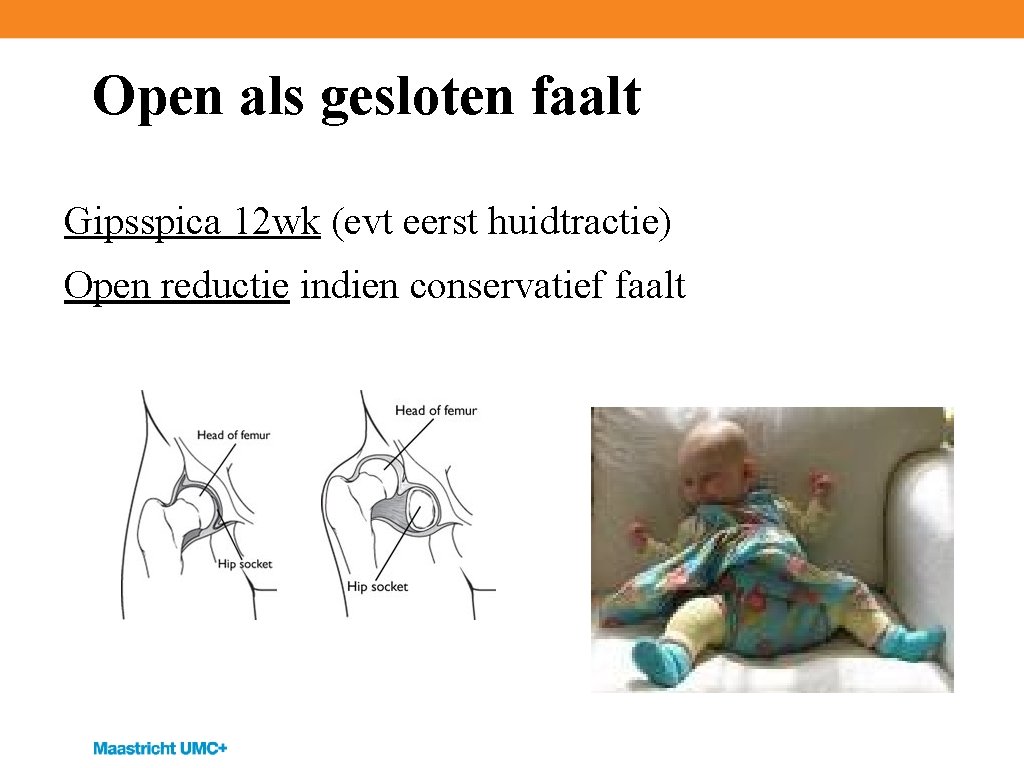 Open als gesloten faalt Gipsspica 12 wk (evt eerst huidtractie) Open reductie indien conservatief