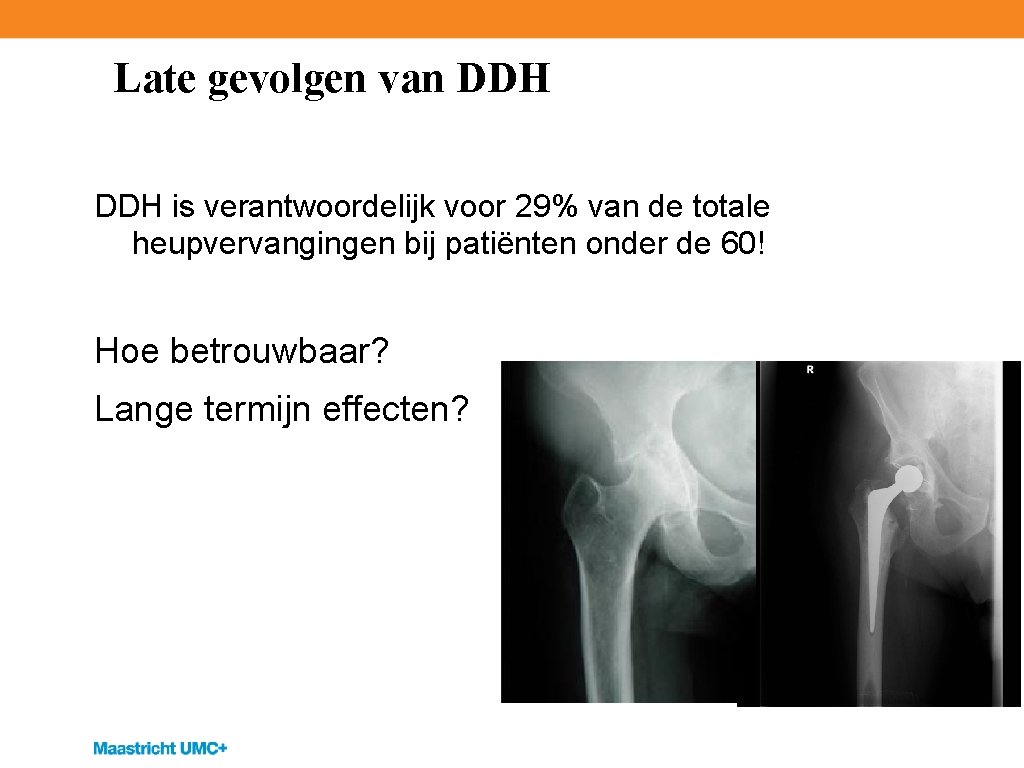 Late gevolgen van DDH is verantwoordelijk voor 29% van de totale heupvervangingen bij patiënten