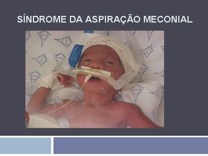 SÍNDROME DA ASPIRAÇÃO MECONIAL 