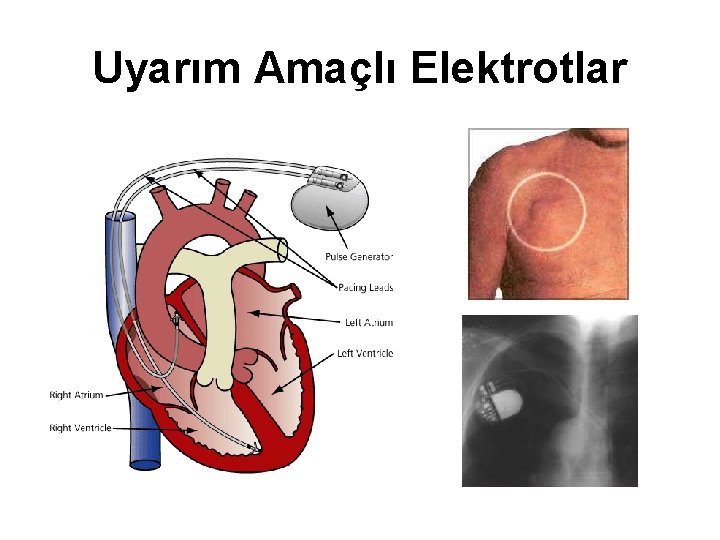 Uyarım Amaçlı Elektrotlar 