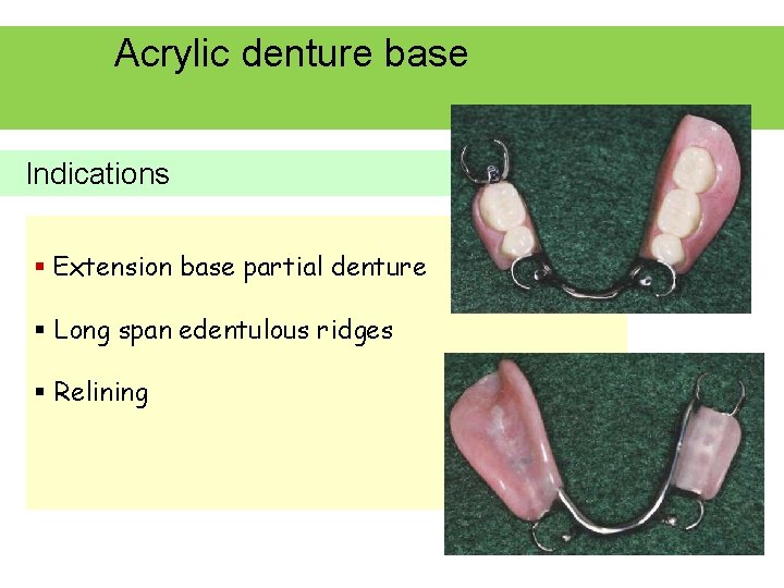 Acrylic denture base Indications § Extension base partial denture § Long span edentulous ridges