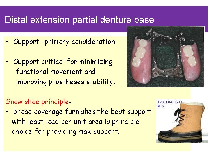 Distal extension partial denture base • Support –primary consideration • Support critical for minimizing