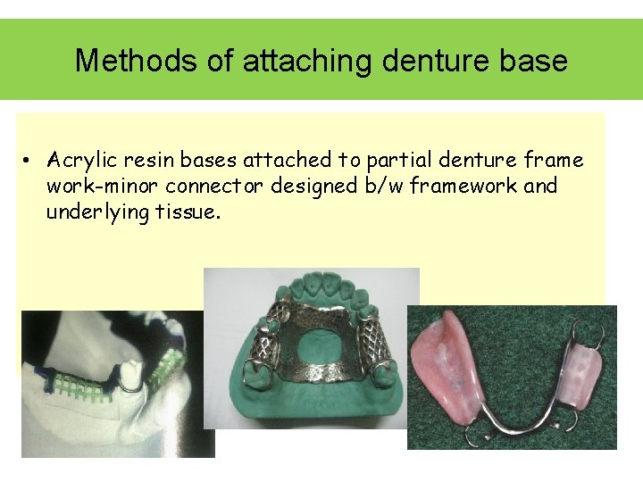 Methods of attaching denture base • Acrylic resin bases attached to partial denture frame