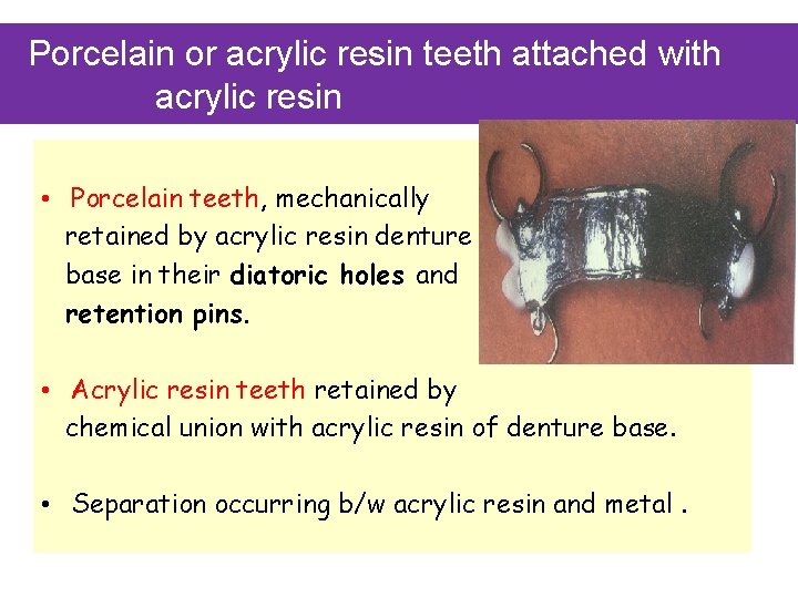 Porcelain or acrylic resin teeth attached with acrylic resin • Porcelain teeth, mechanically retained