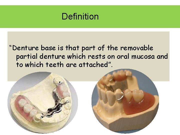 Definition “Denture base is that part of the removable partial denture which rests on