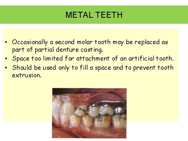 METAL TEETH • Occasionally a second molar tooth may be replaced as part of