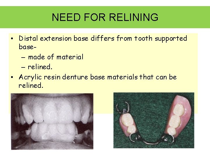 NEED FOR RELINING • Distal extension base differs from tooth supported base– made of