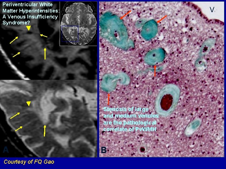 Periventricular White Matter Hyperintensities: A Venous Insufficiency Syndrome? V Stenosis of large and medium