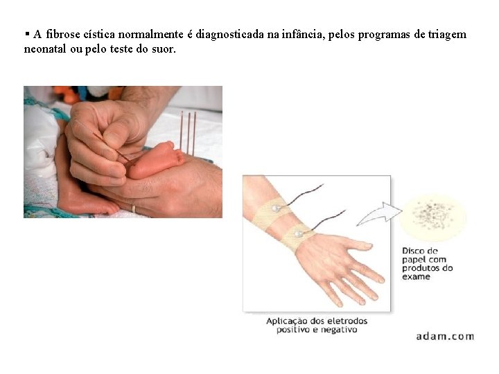 § A fibrose cística normalmente é diagnosticada na infância, pelos programas de triagem neonatal