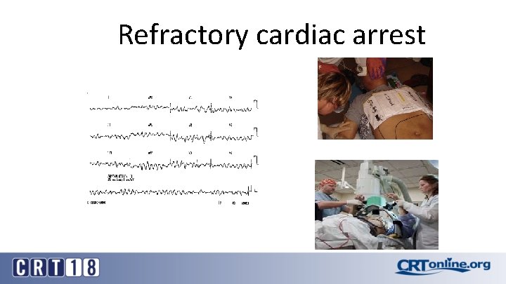 Refractory cardiac arrest 