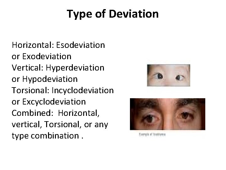 Type of Deviation Horizontal: Esodeviation or Exodeviation Vertical: Hyperdeviation or Hypodeviation Torsional: Incyclodeviation or Type of Deviation Horizontal: Esodeviation or Exodeviation Vertical: Hyperdeviation or Hypodeviation Torsional: Incyclodeviation or