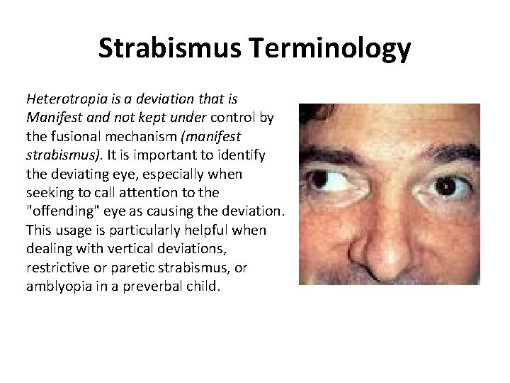 Strabismus Terminology Heterotropia is a deviation that is Manifest and not kept under control Strabismus Terminology Heterotropia is a deviation that is Manifest and not kept under control